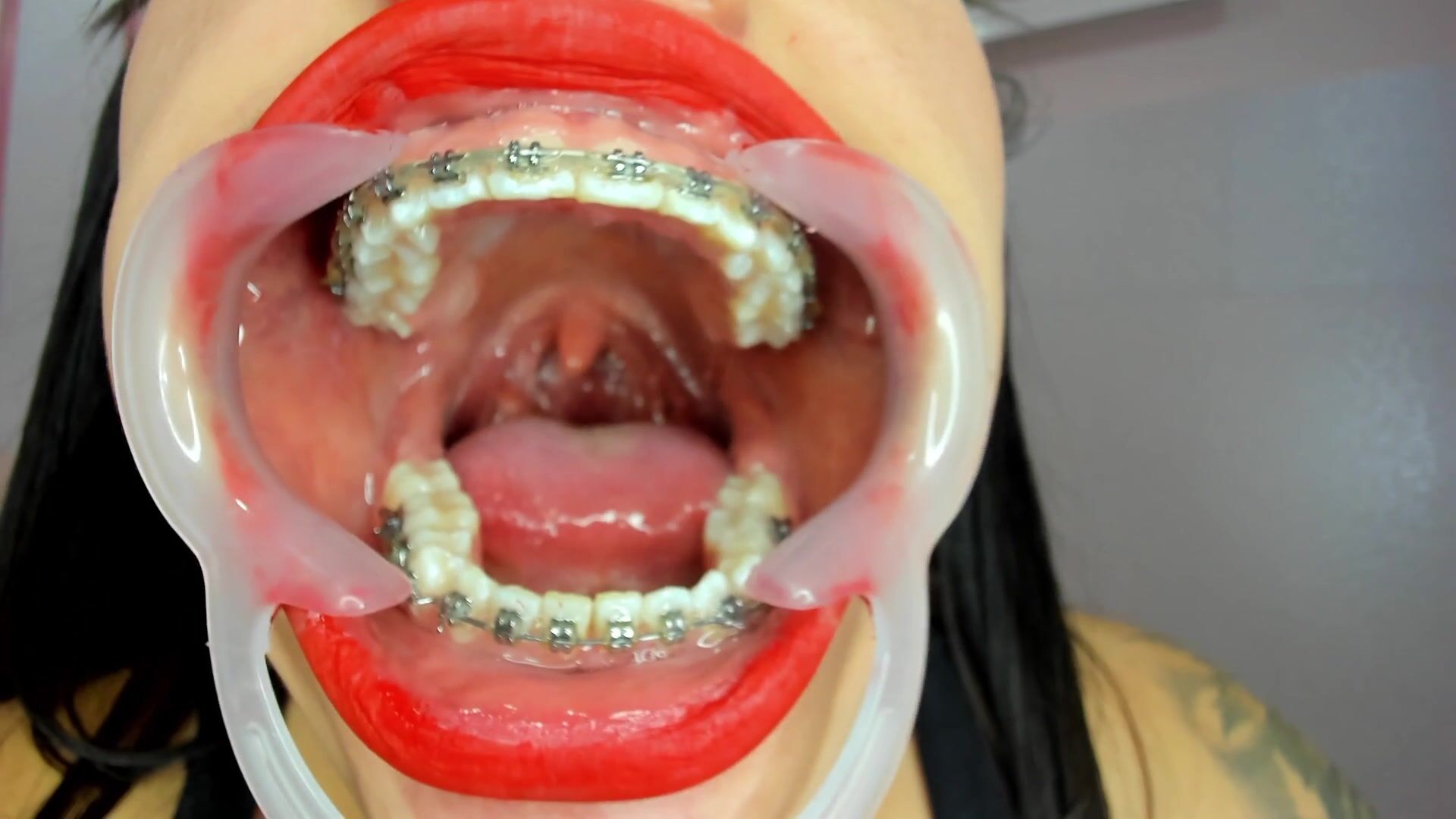 mouth + expander