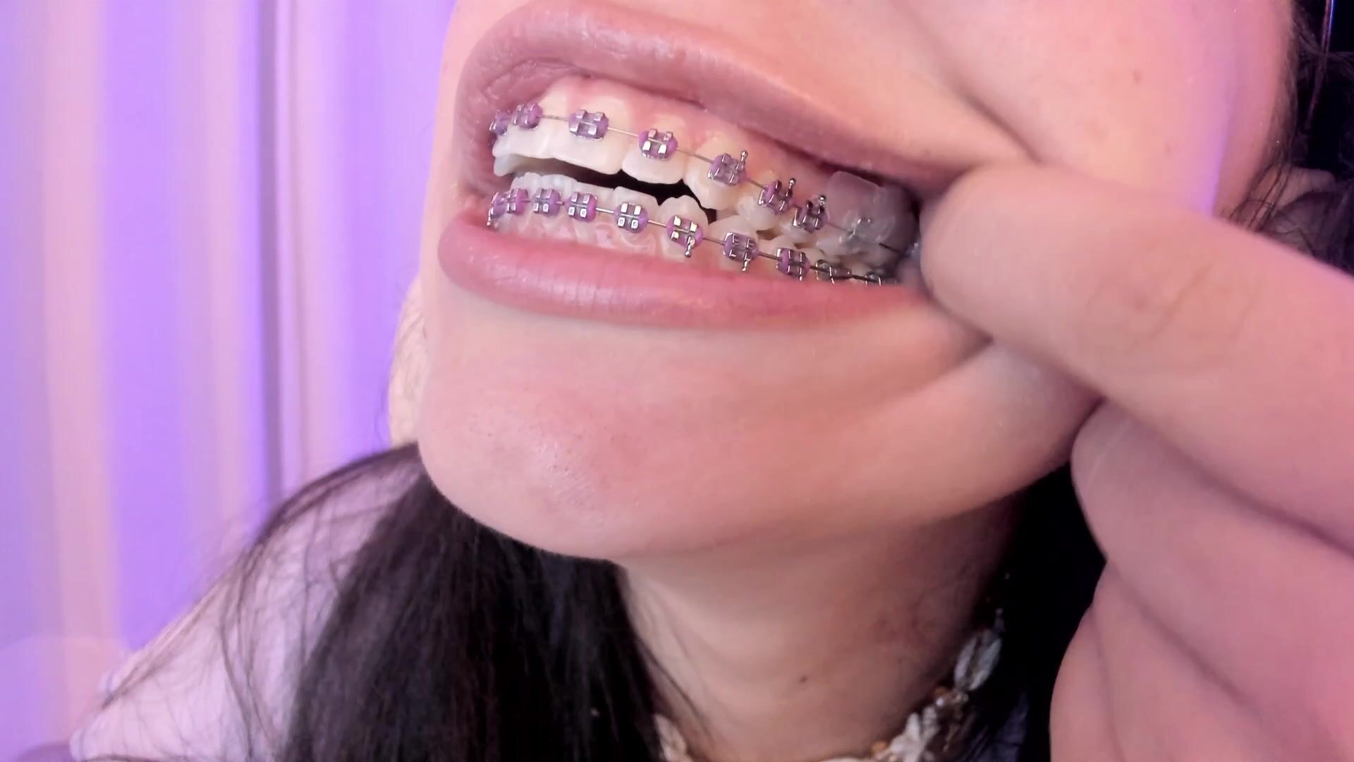 Braces Close Up And Saliva