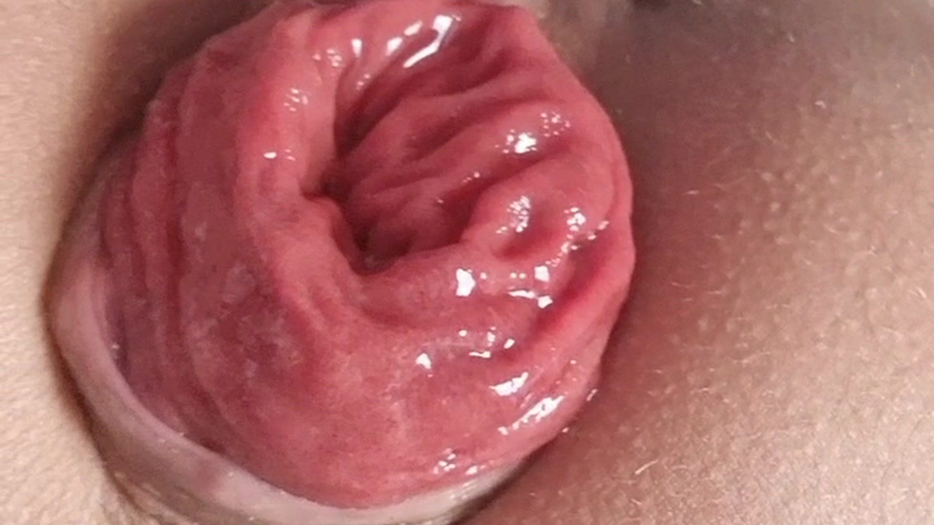 Prolapse anal