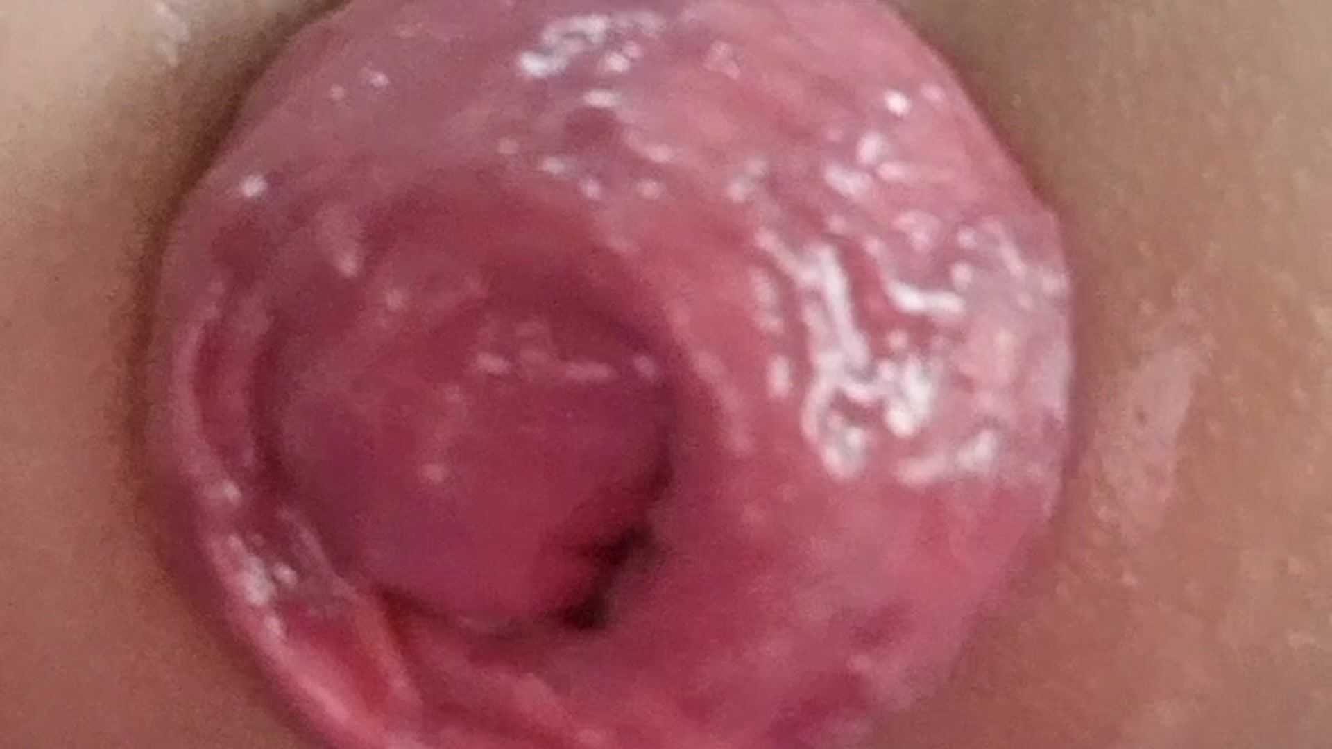 Prolapse anal