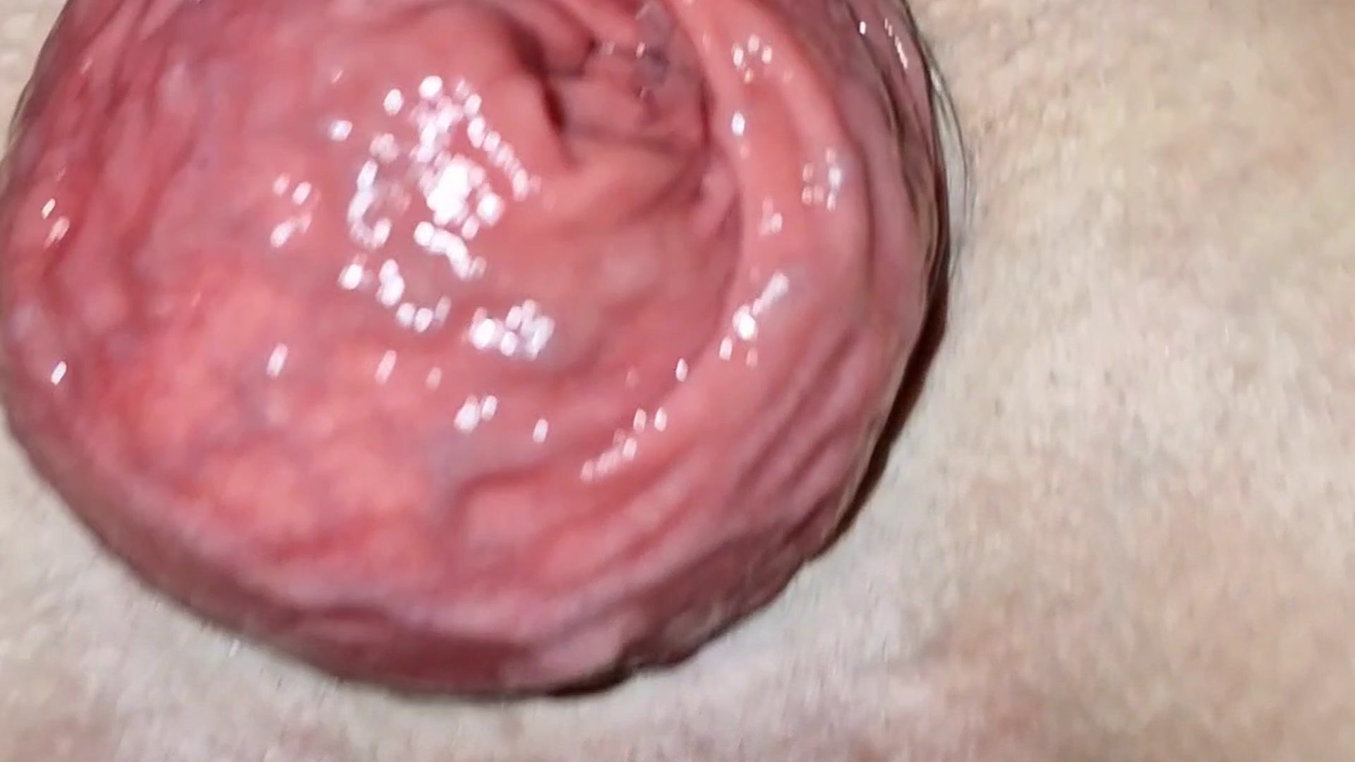 Prolapse anal