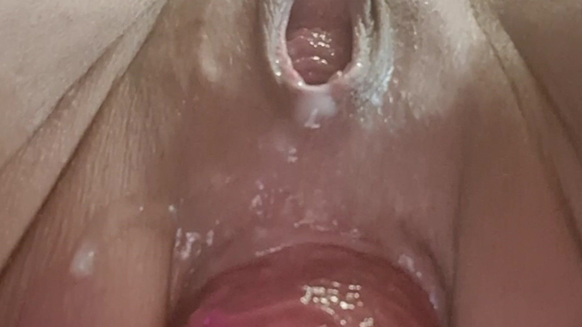 Prolapse anal