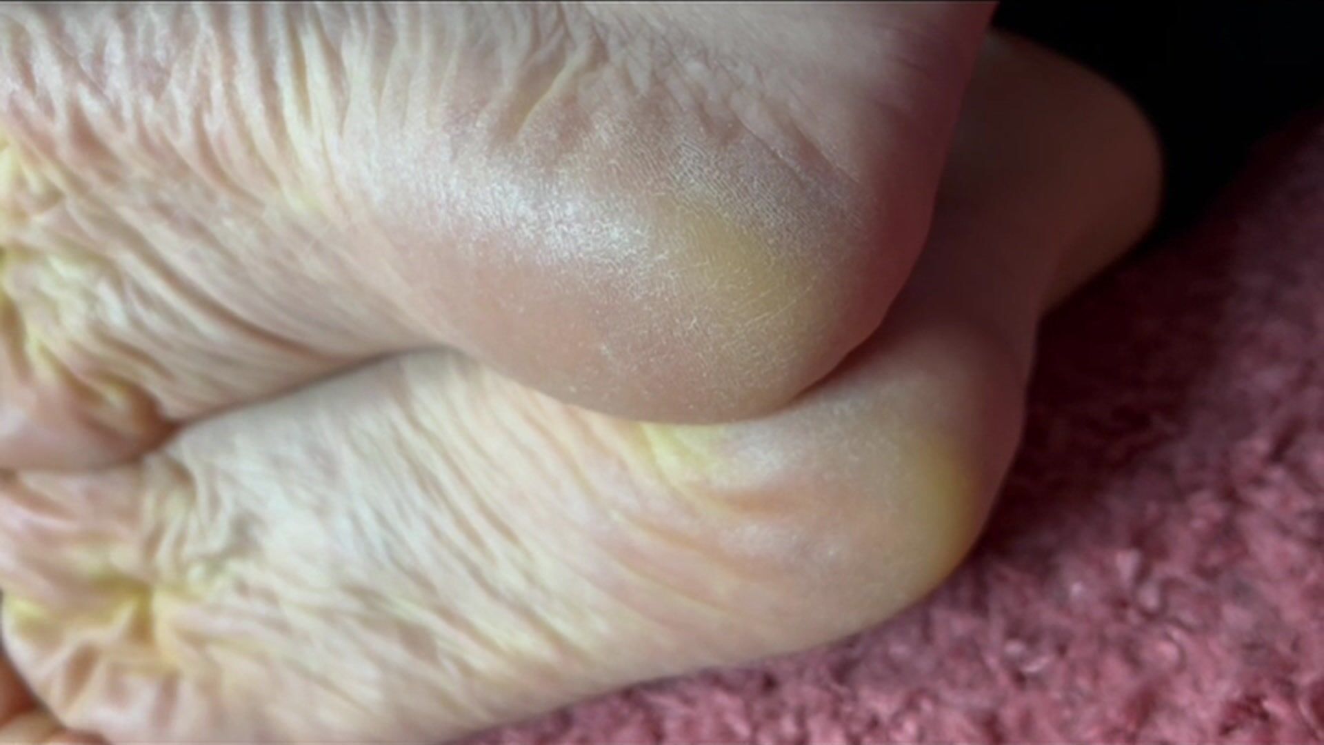 Hard dry soles skin PART 2